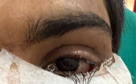 स्किन ग्राफ्टिंग से मरीज के पलक का सफल पुनर्निर्माण