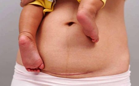 सिजेरियन डिलीवरी का बढ़ता चलन,मेडिकल जरूरत या बड़ा बिज़नेस?