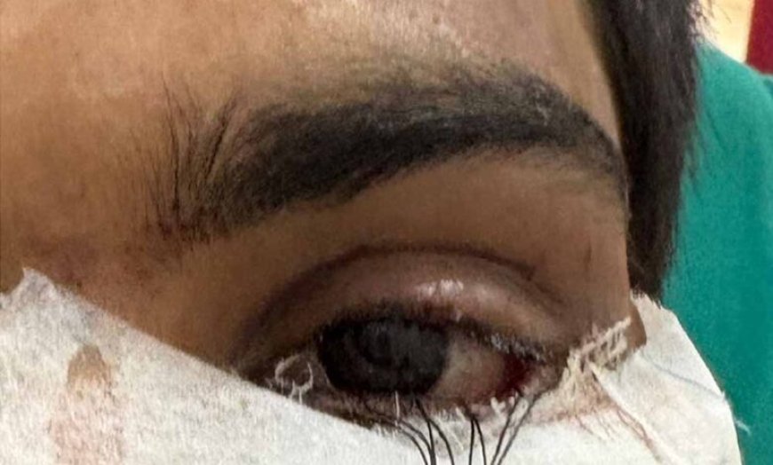 स्किन ग्राफ्टिंग से मरीज के पलक का सफल पुनर्निर्माण