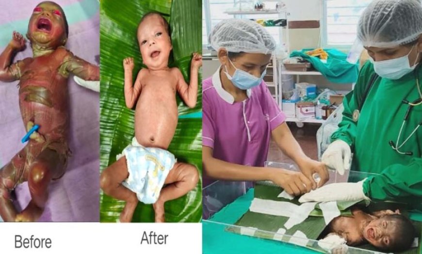 अत्यंत दुर्लभ बीमारी से जूझ रहे नवजात को बीजापुर जिला अस्पताल की SNCU में मिला नया जीवन